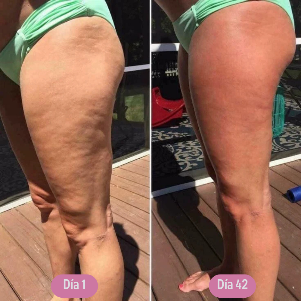 SculptEase™